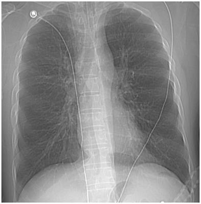 Extracorporeal membrane oxygenation treatment for severe asthma had unexpected adverse effects: a case report